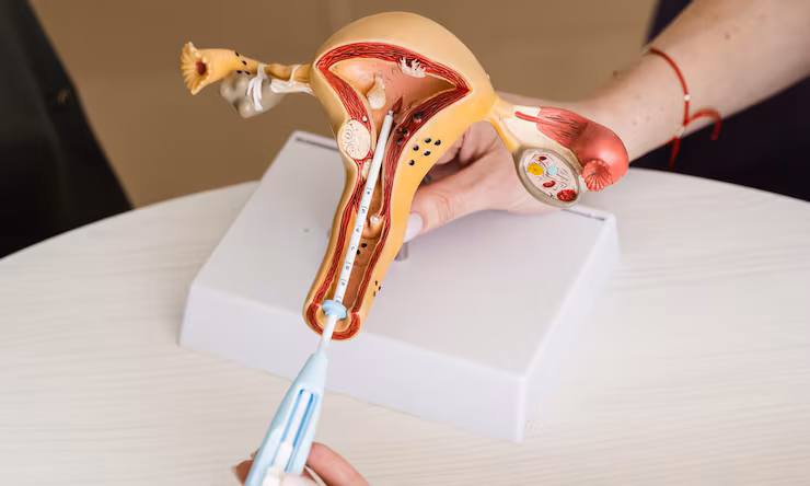 Laparoscopic cervical cerclage