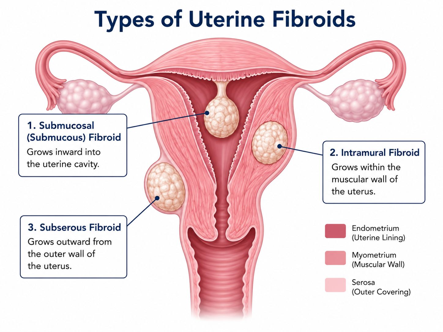 sub-mucus-intramural-Subserous-fibroids